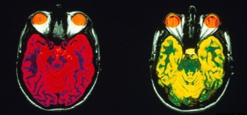 MRI_scans